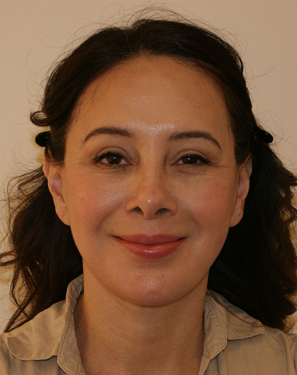 Photo of Patient 01 After Face And Neck Lift Procedure