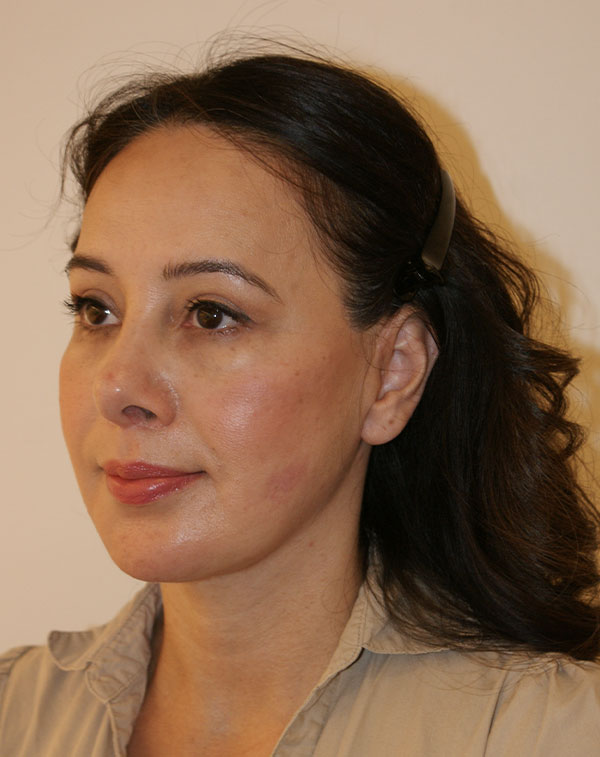 Photo of Patient 01 After Face And Neck Lift Procedure