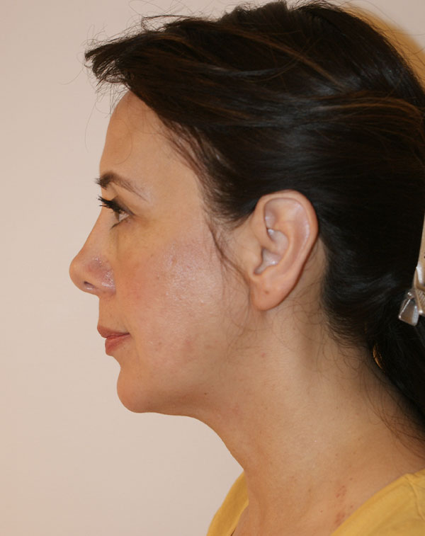 Photo of Patient 01 Before Face And Neck Lift Procedure