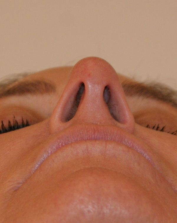 Photo of Patient 01 Before Face And Neck Lift Procedure