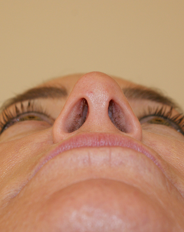 Photo of Patient 01 After Face And Neck Lift Procedure
