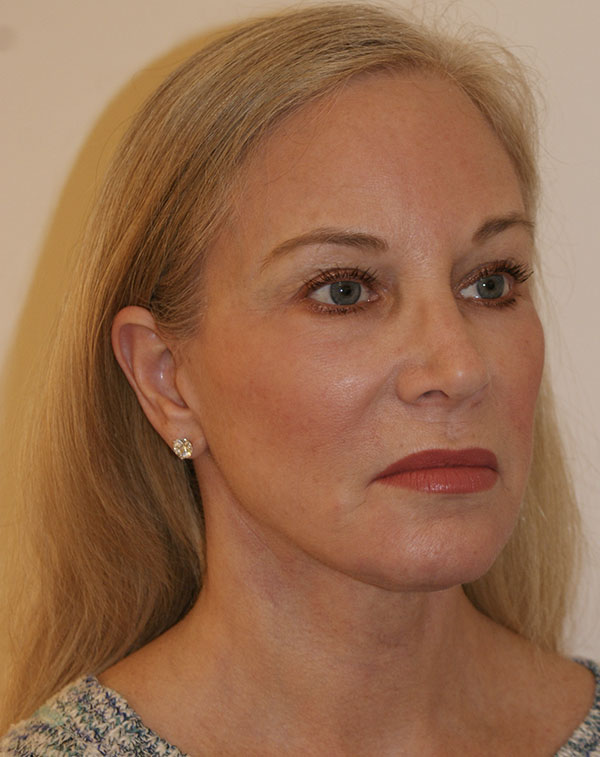 Photo of Patient 03 After Face And Neck Lift Procedure