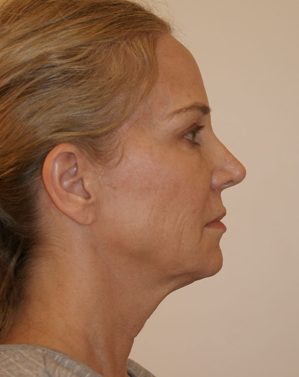Photo of Patient 03 Before Face And Neck Lift Procedure