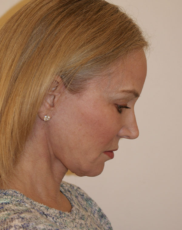 Photo of Patient 03 After Face And Neck Lift Procedure