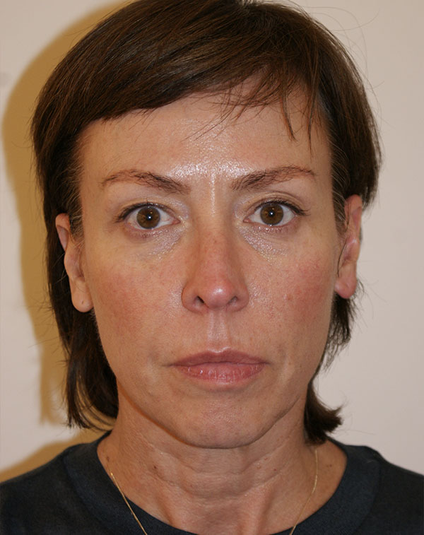 Photo of Patient 04 Before Face And Neck Lift Procedure