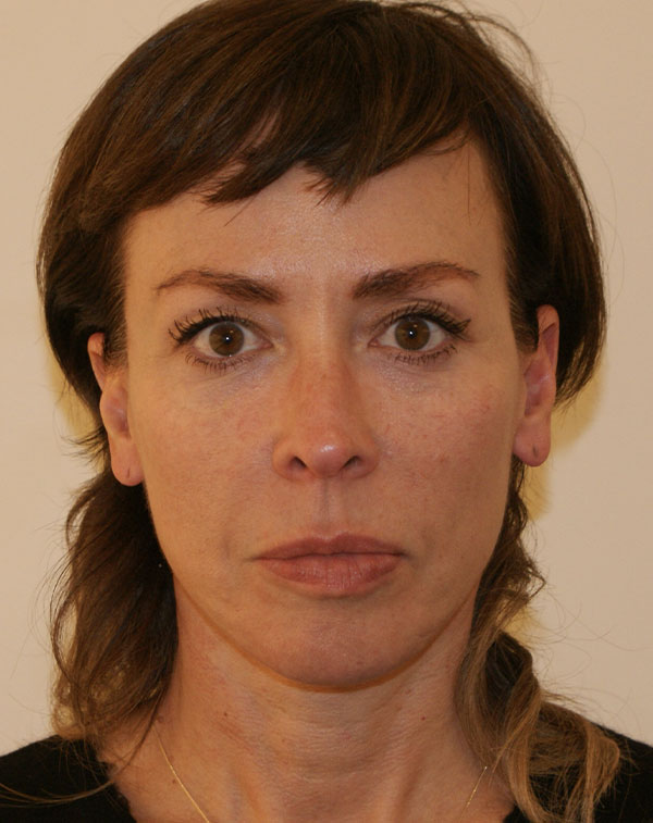 Photo of Patient 04 After Face And Neck Lift Procedure