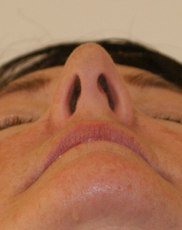 Photo of Patient 04 Before Face And Neck Lift Procedure