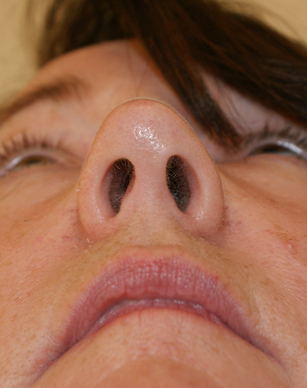 Photo of Patient 04 After Face And Neck Lift Procedure