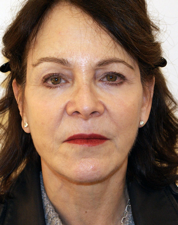 Photo of Patient 05 After Face And Neck Lift Procedure