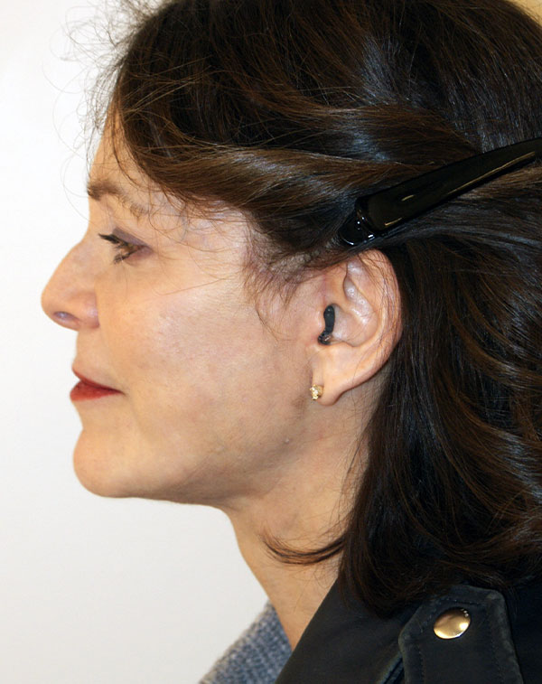 Photo of Patient 05 After Face And Neck Lift Procedure