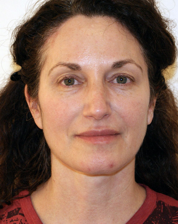 Photo of Patient 06 After Face And Neck Lift Procedure