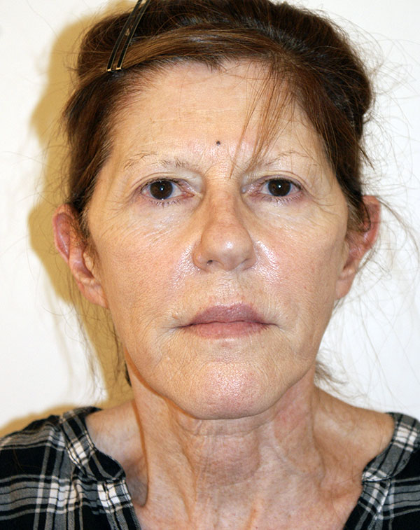 Photo of Patient 07 Before Face And Neck Lift Procedure