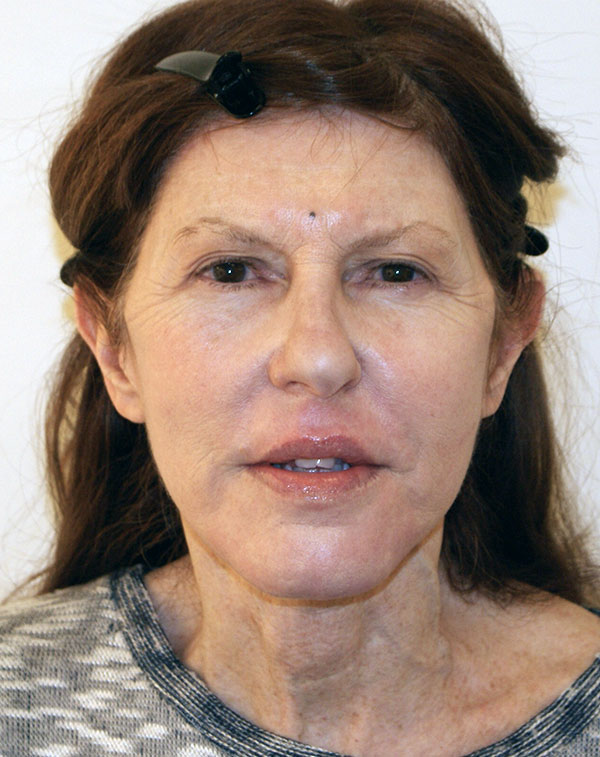 Photo of Patient 07 After Face And Neck Lift Procedure