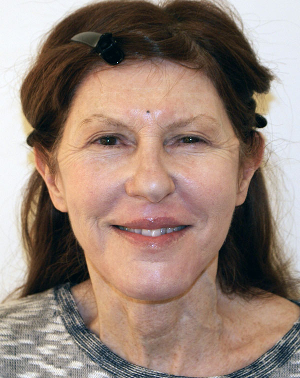 Photo of Patient 07 After Face And Neck Lift Procedure