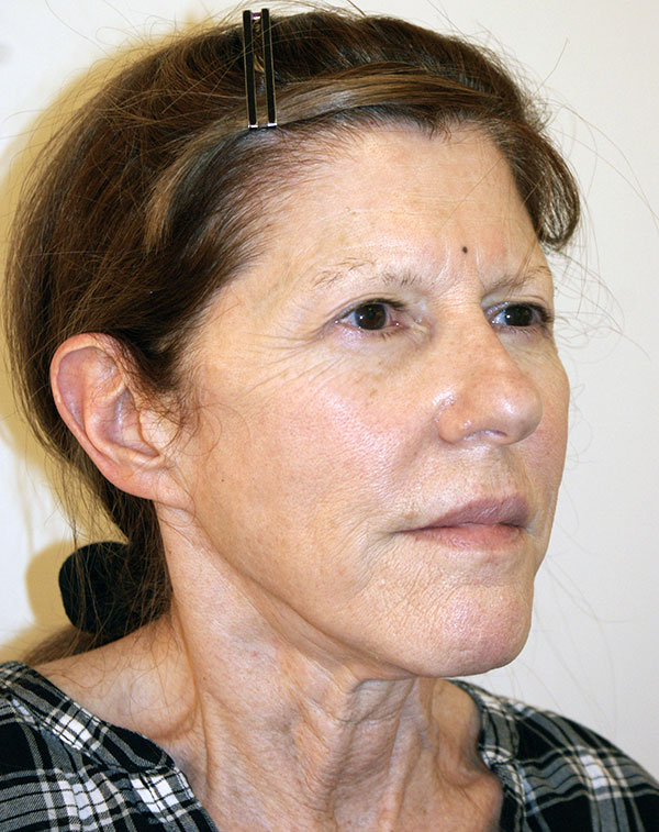 Photo of Patient 07 Before Face And Neck Lift Procedure