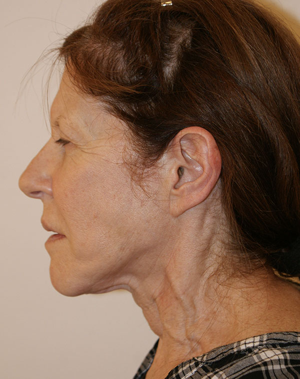 Photo of Patient 07 Before Face And Neck Lift Procedure