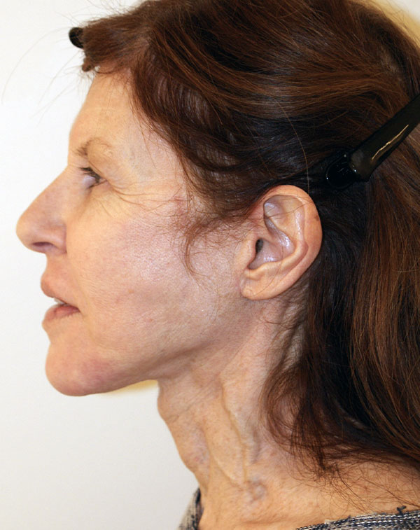 Photo of Patient 07 After Face And Neck Lift Procedure