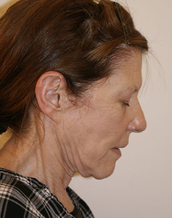 Photo of Patient 07 Before Face And Neck Lift Procedure