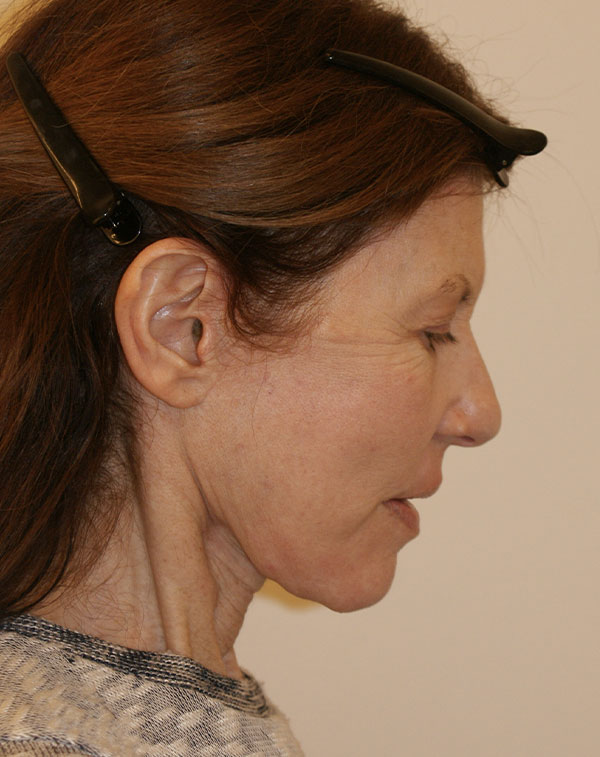 Photo of Patient 07 After Face And Neck Lift Procedure