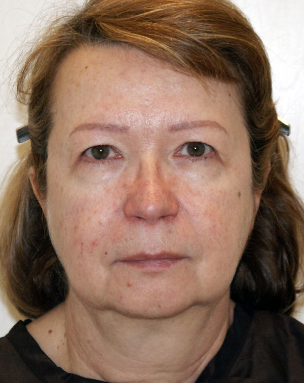 Photo of Patient 08 Before Face And Neck Lift Procedure
