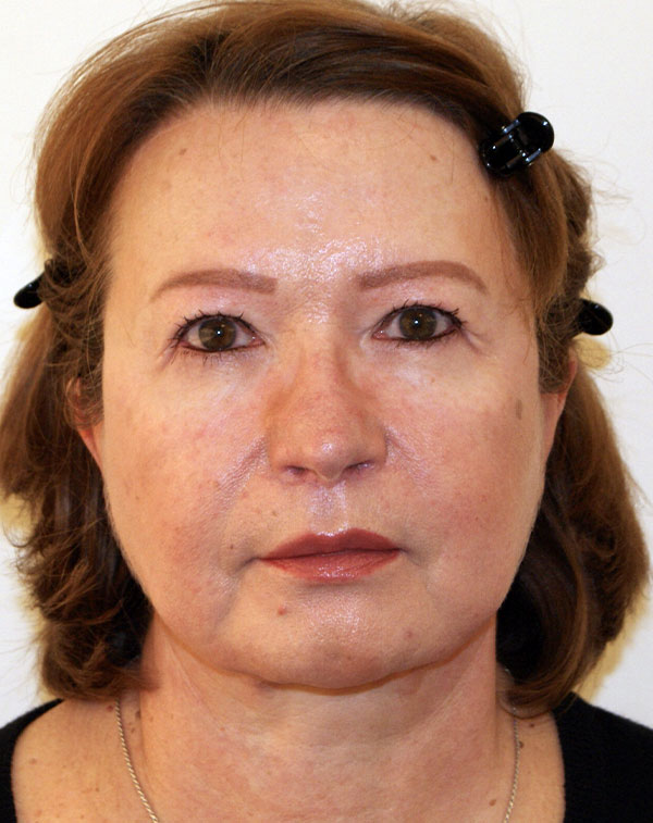 Photo of Patient 08 After Face And Neck Lift Procedure