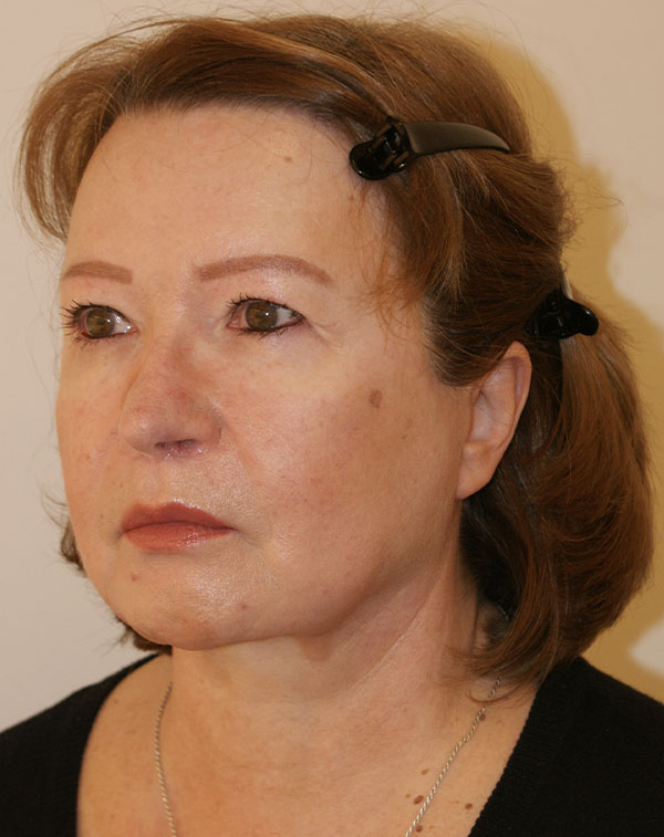 Photo of Patient 08 After Face And Neck Lift Procedure