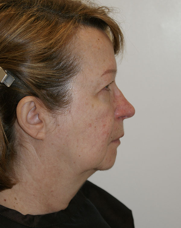 Photo of Patient 08 Before Face And Neck Lift Procedure