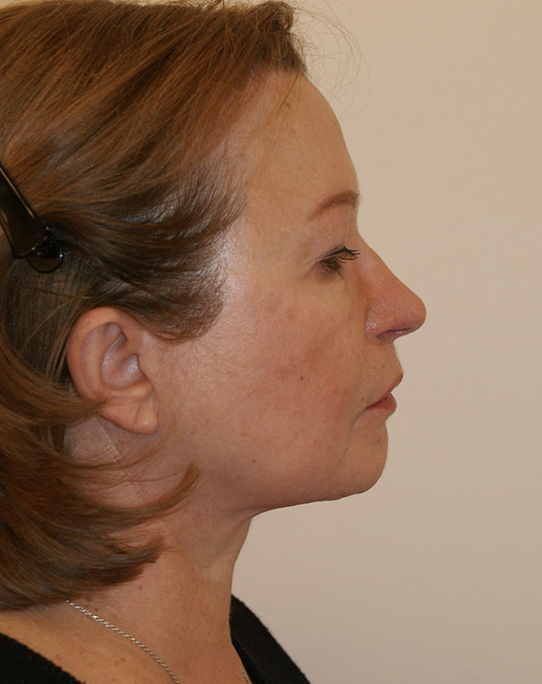 Photo of Patient 08 After Face And Neck Lift Procedure