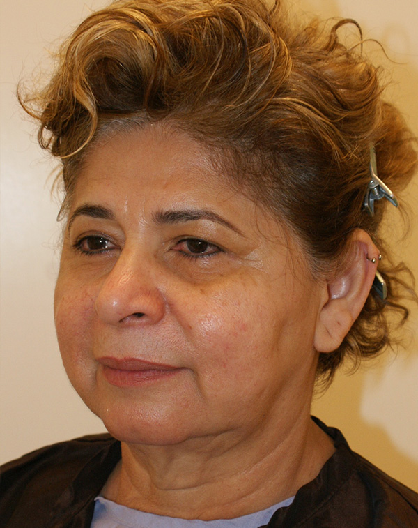 Photo of Patient 08 Before Face And Neck Lift Procedure
