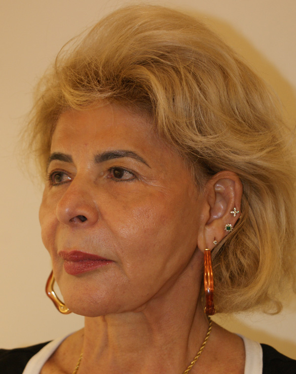 Photo of Patient 08 After Face And Neck Lift Procedure