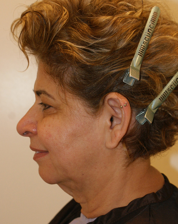 Photo of Patient 08 Before Face And Neck Lift Procedure