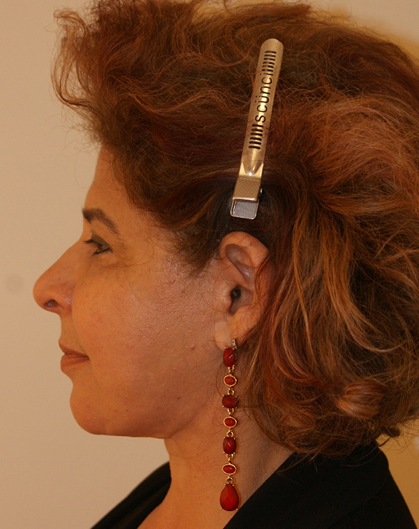 Photo of Patient 08 After Face And Neck Lift Procedure