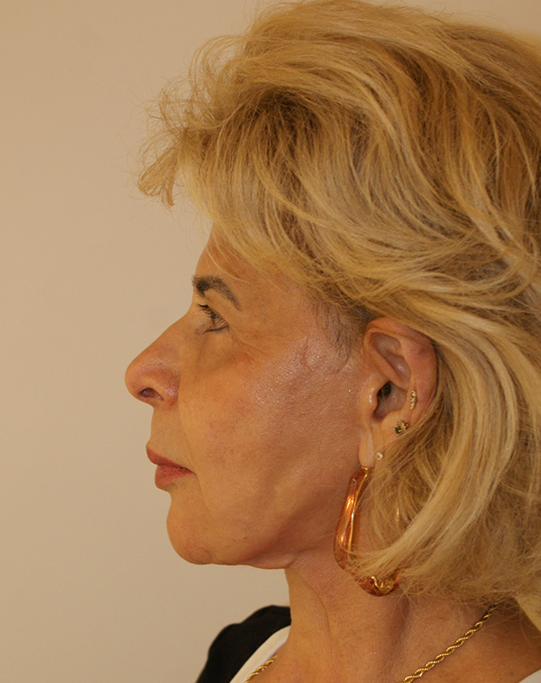 Photo of Patient 08 After Face And Neck Lift Procedure