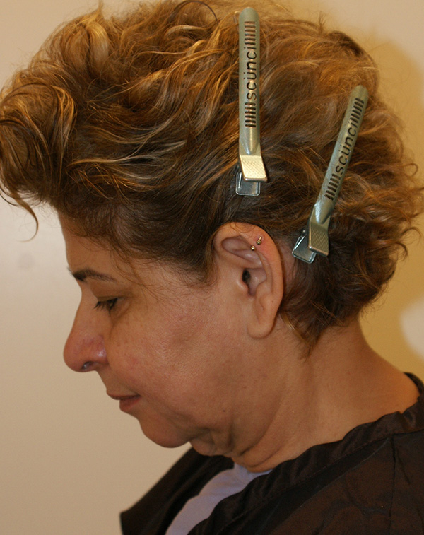 Photo of Patient 08 Before Face And Neck Lift Procedure