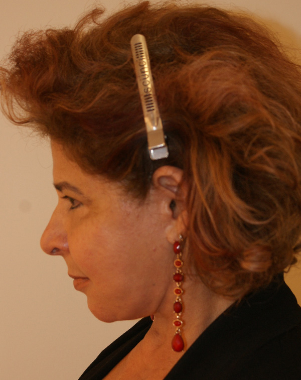 Photo of Patient 08 Before Face And Neck Lift Procedure