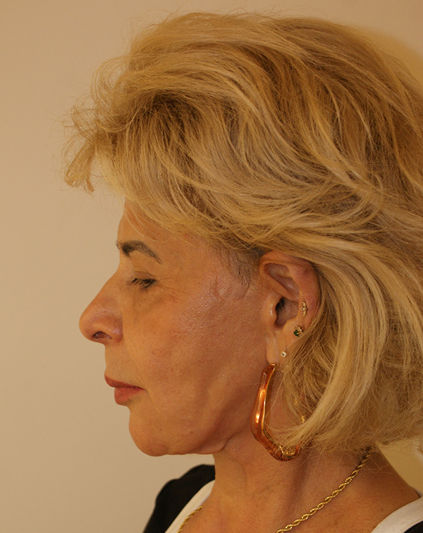 Photo of Patient 08 After Face And Neck Lift Procedure
