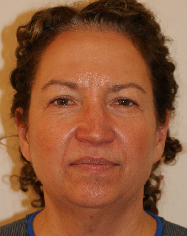 Photo of Patient 09 Before Face And Neck Lift Procedure