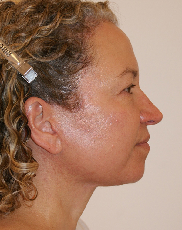 Photo of Patient 09 After Face And Neck Lift Procedure