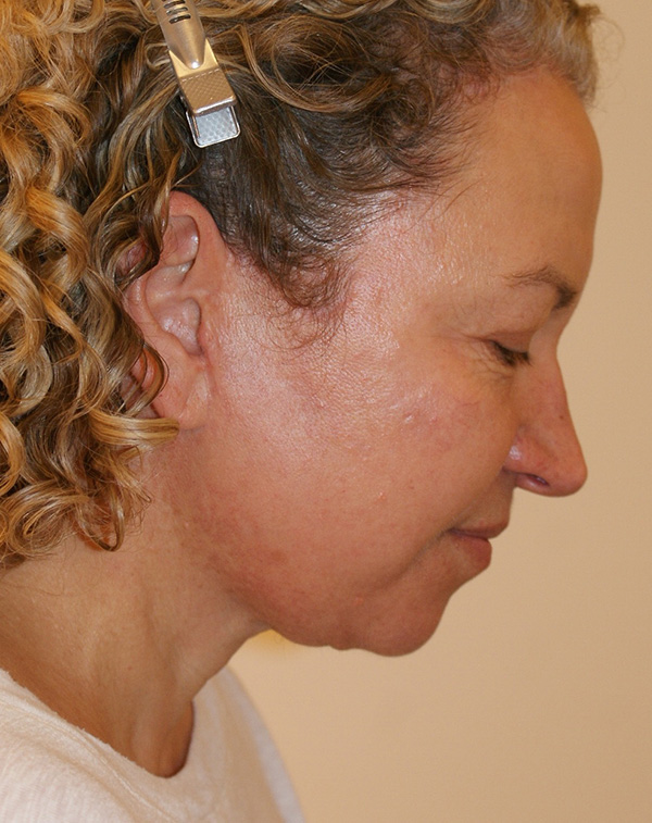 Photo of Patient 09 After Face And Neck Lift Procedure