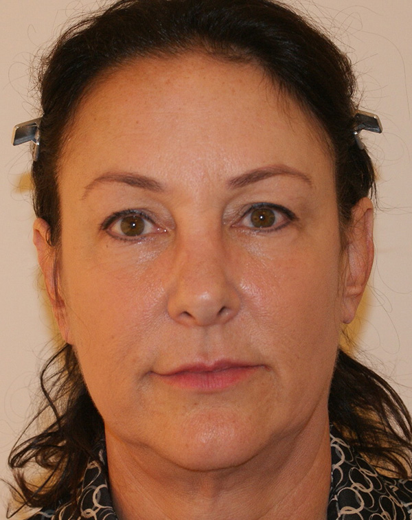 Photo of Patient 10 Before Face And Neck Lift Procedure