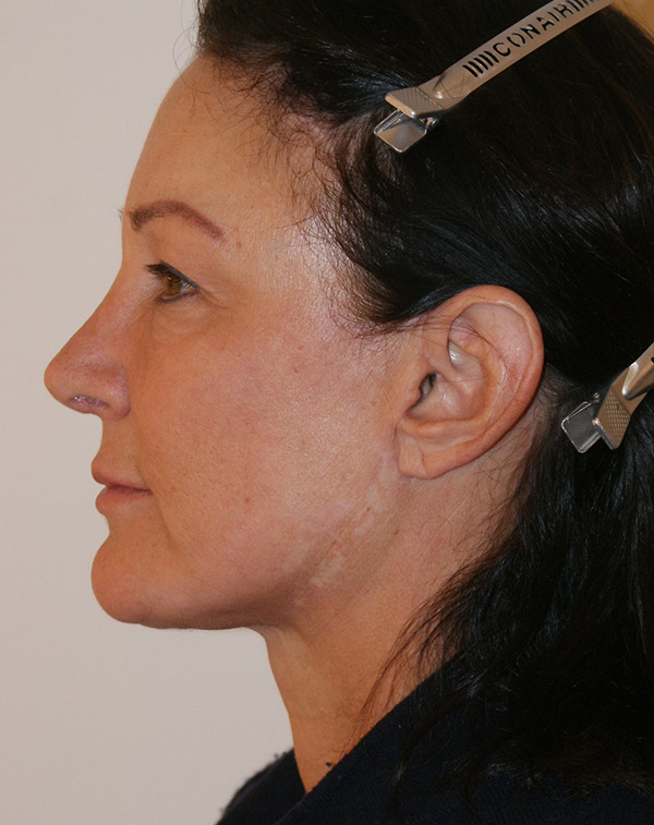 Photo of Patient 10 After Face And Neck Lift Procedure