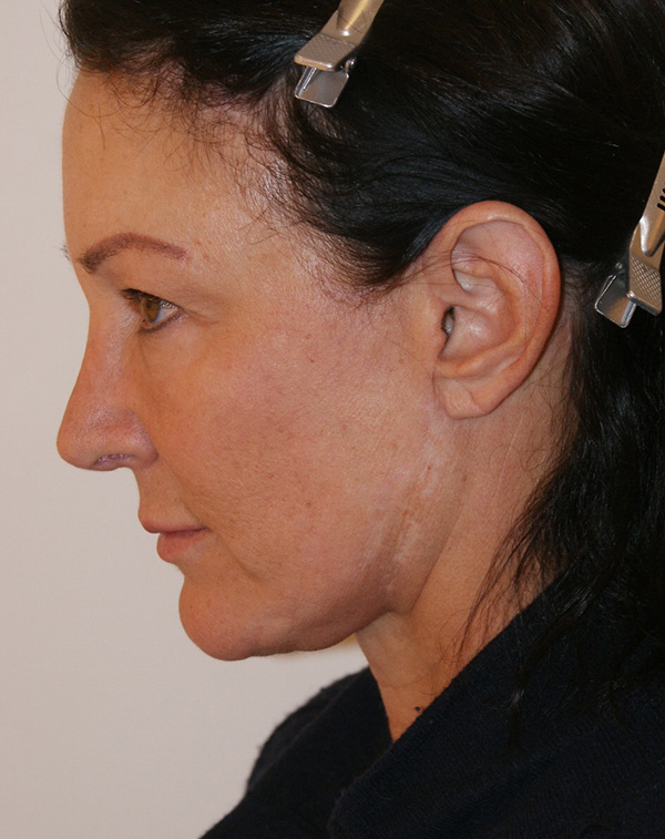 Photo of Patient 10 After Face And Neck Lift Procedure