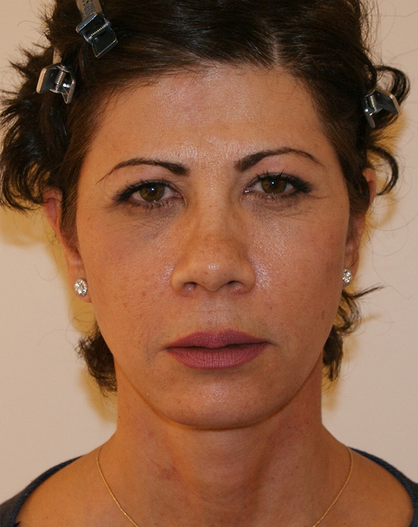 Photo of Patient 11 After Face And Neck Lift Procedure