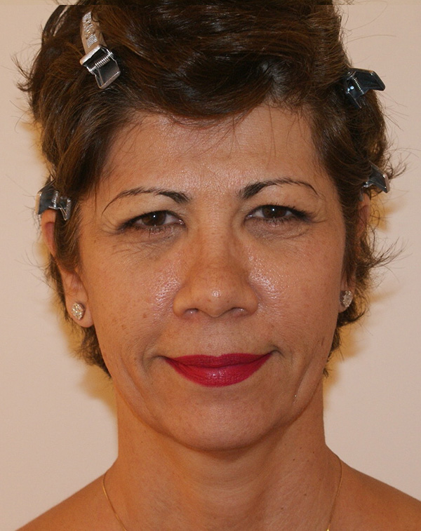 Photo of Patient 11 Before Face And Neck Lift Procedure