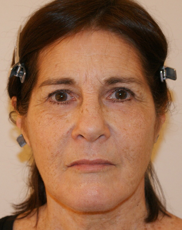 Photo of Patient 13 After Face And Neck Lift Procedure