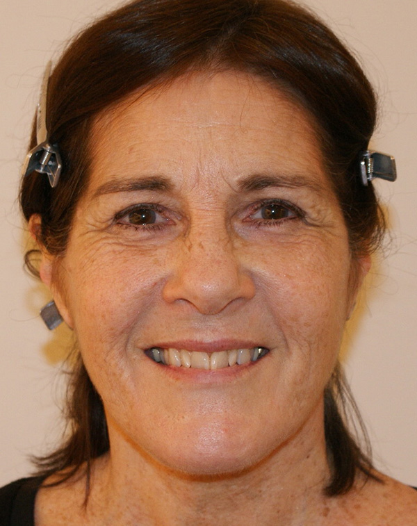 Photo of Patient 13 After Face And Neck Lift Procedure