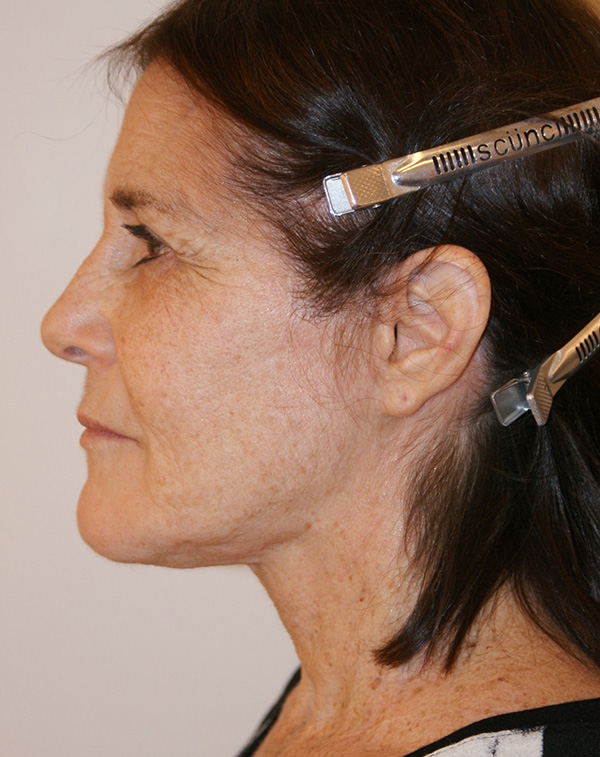 Photo of Patient 13 After Face And Neck Lift Procedure