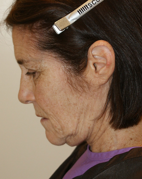 Photo of Patient 13 Before Face And Neck Lift Procedure