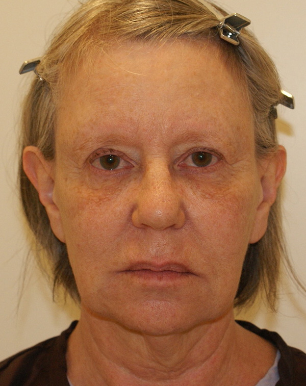 Photo of Patient 14 Before Face And Neck Lift Procedure