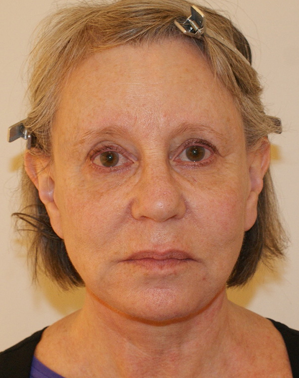 Photo of Patient 14 After Face And Neck Lift Procedure